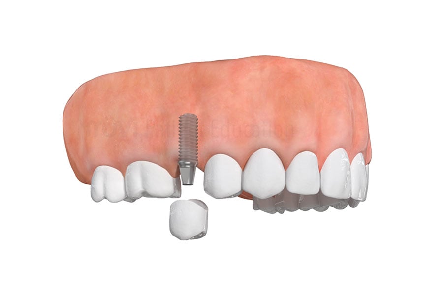 Dental Implants in Lyndhurst, OH
